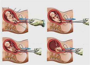 Aborto1.jpg